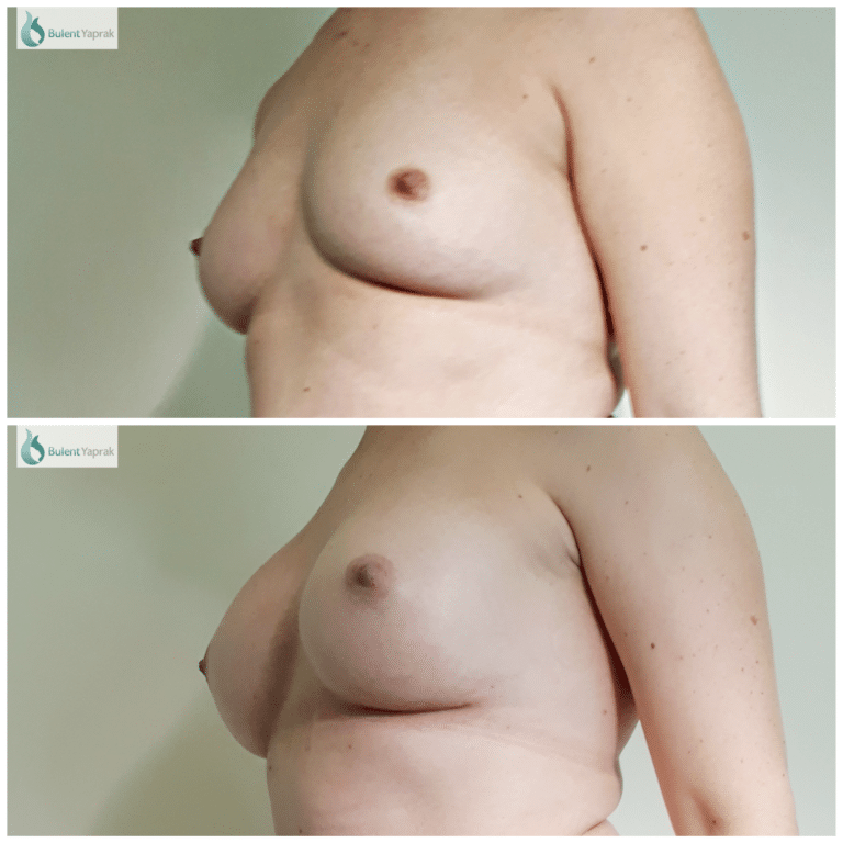 Breast Enlargement Before and After Photo by Bulent Yaprak - Plastic Sugeon Hamilton
