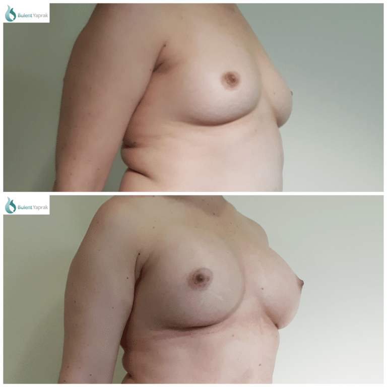Breast Implant Before and After Bulent Yaprak