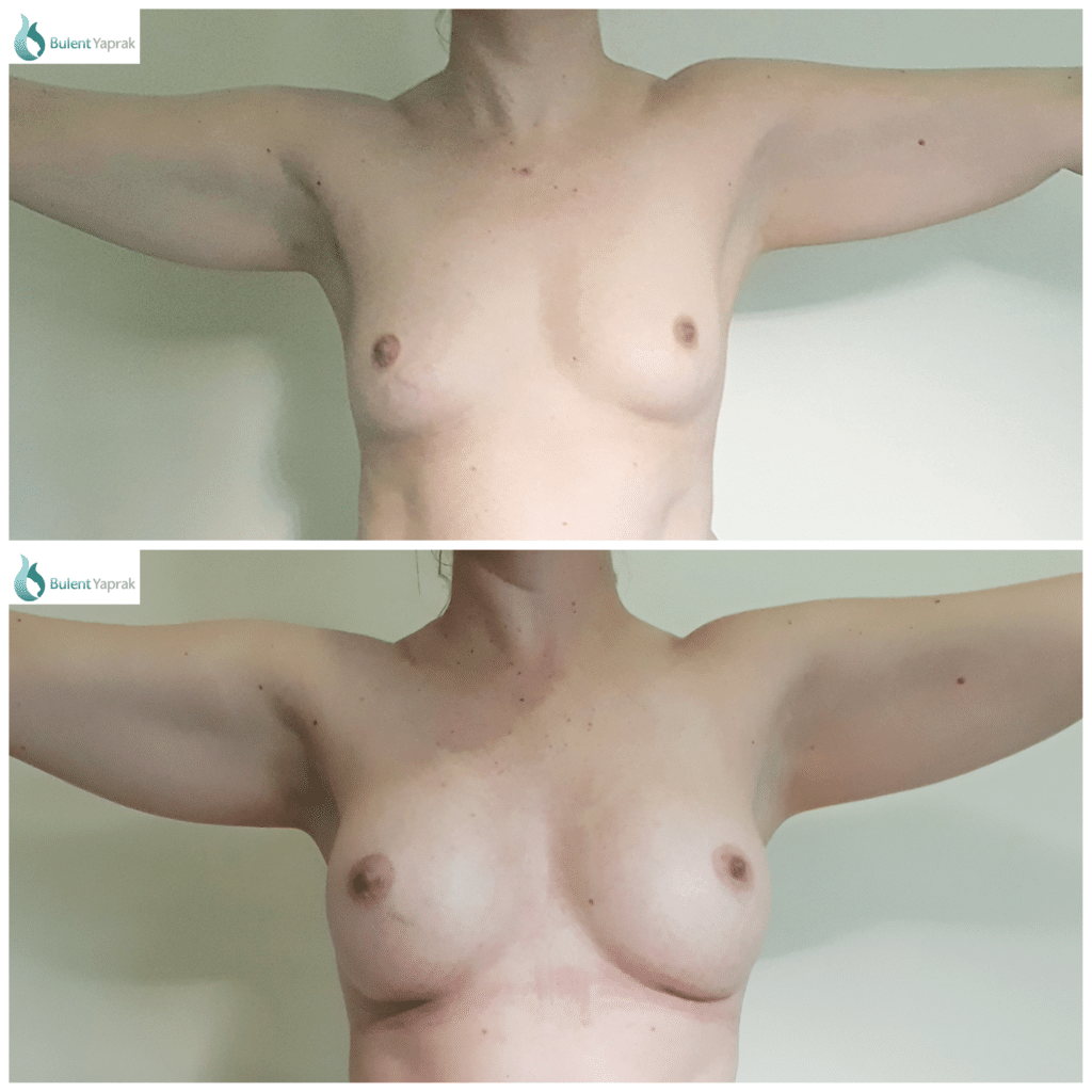 Breast Enlargement before and after Bulent Yaprak