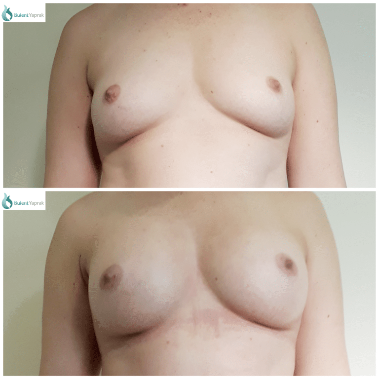 Breast Augmentation Before and after photo Bulent Yaprak front arms down