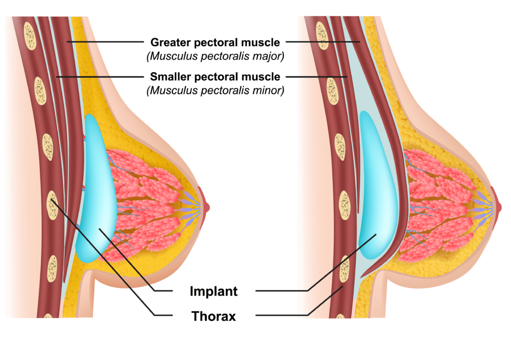 Breast Enlargement - Implant Placement