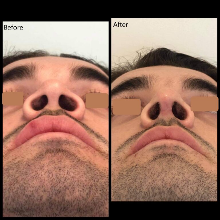 Rhinoplasty before and after patient from the bottom