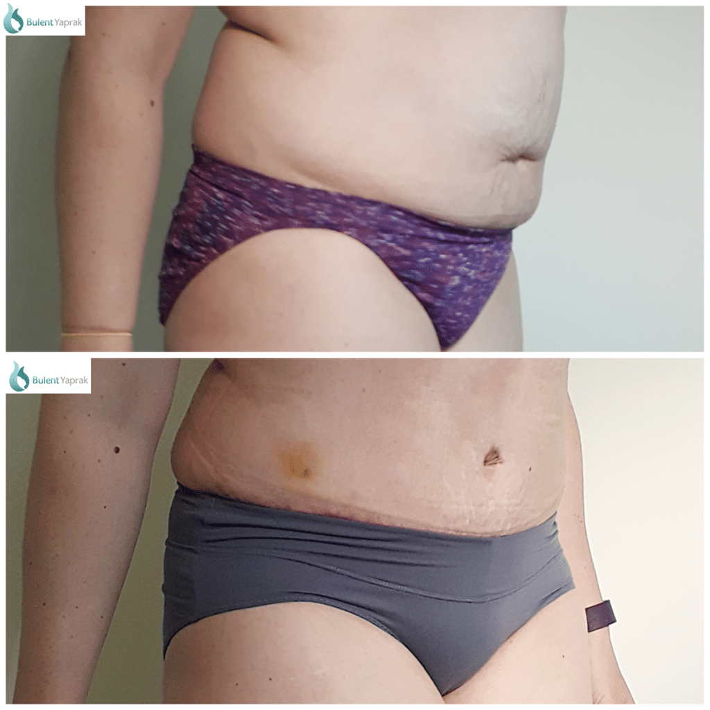 Tummy tuck abdominoplasty pateint Plastic Sugery before and after side on