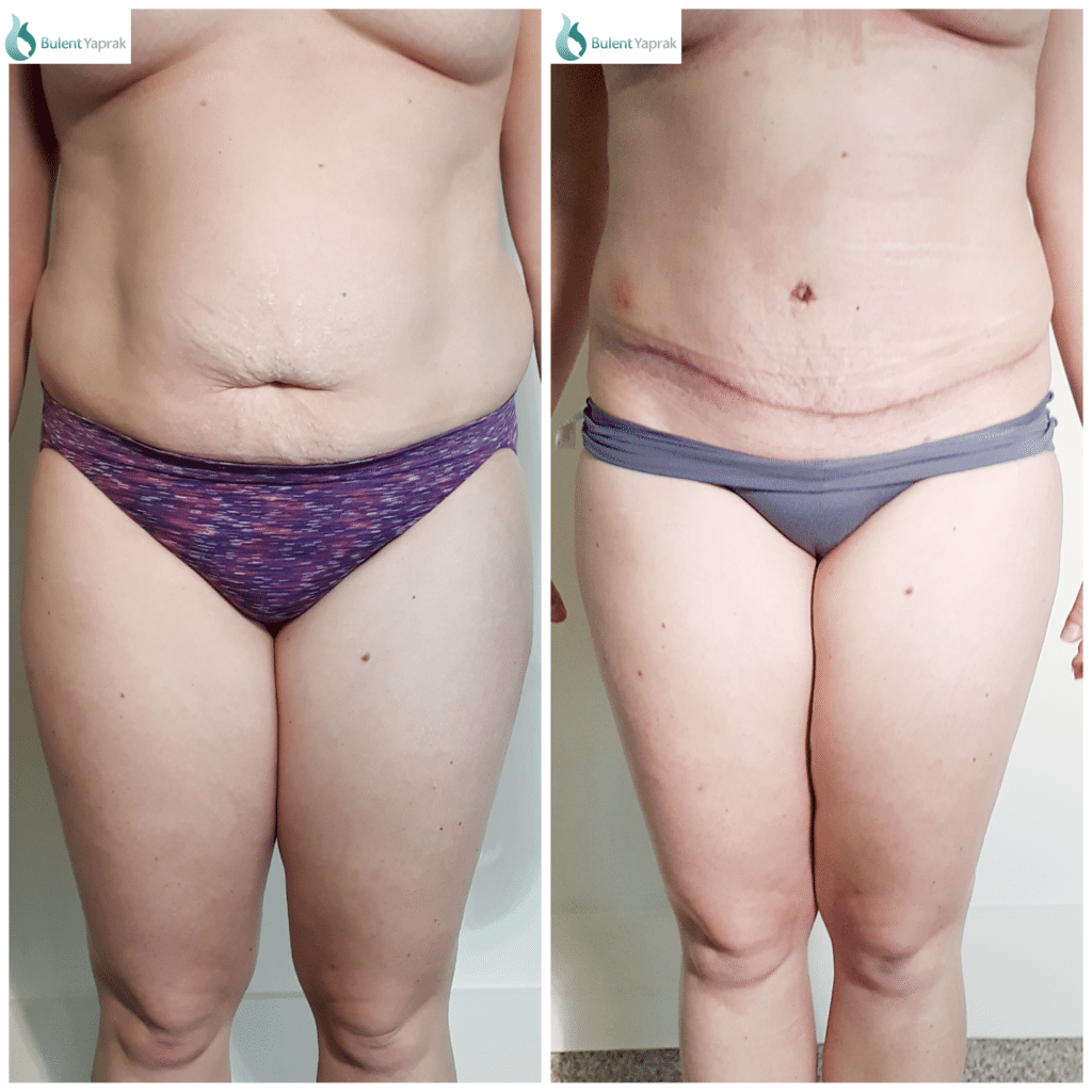 Tummy tuck Before and After Bulent Yaprak