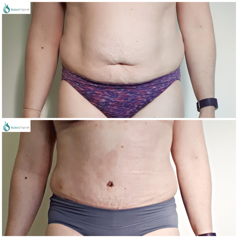 Eliminating A Bulging Belly With A Tummy Tuck - Dr Hamid Our