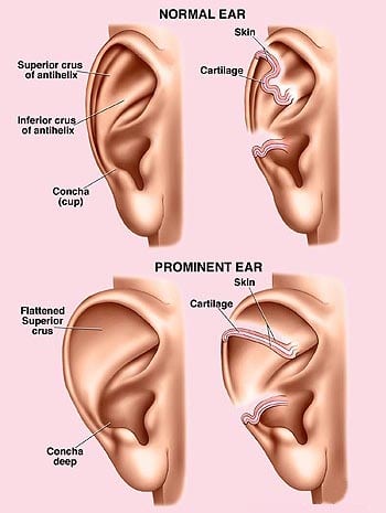 Otoplasty Explained cartilage incision line how it works