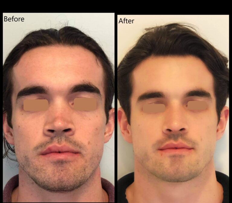 Rhinoplasty patient before and after photos by Bulent Yaprak plastic surgeon