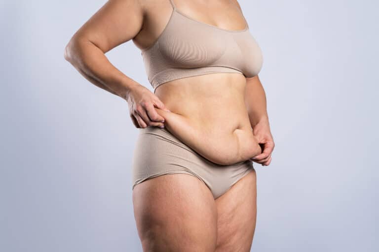 Tummy tuck flabby skin - Dr Yaprak surgeon