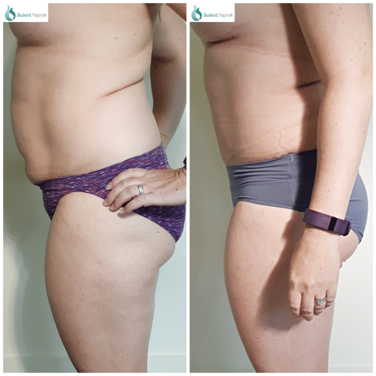 Swelling After Tummy Tuck  How Long & How To Address