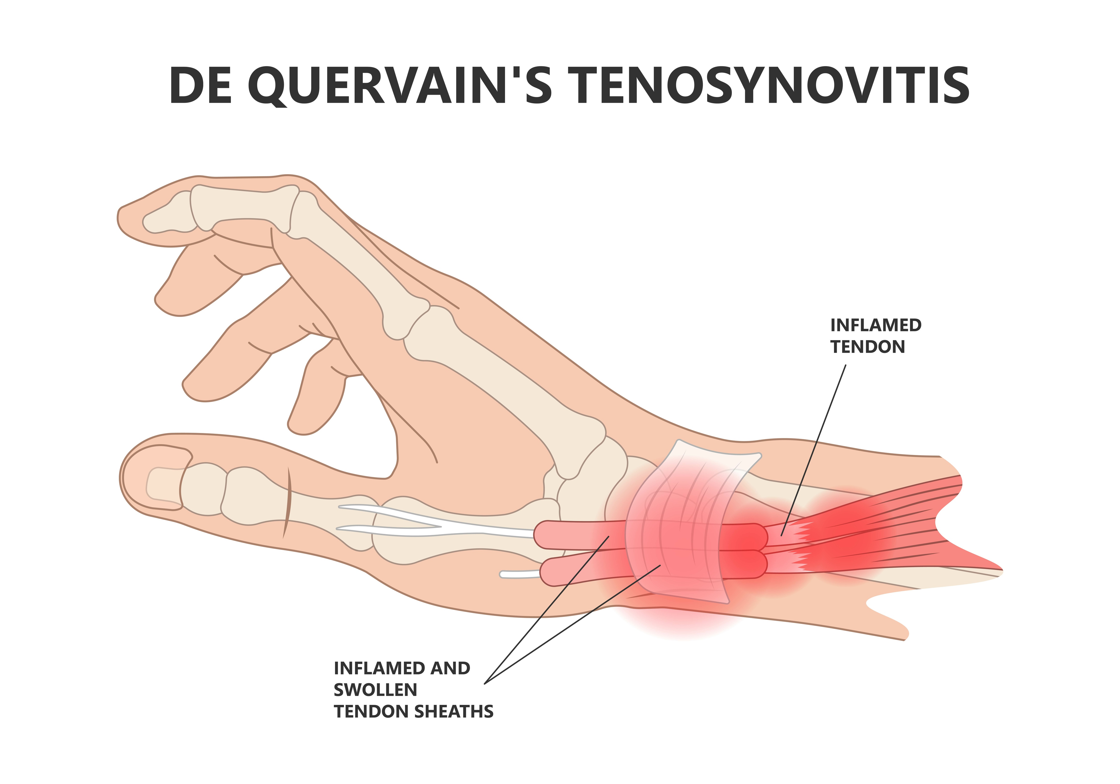 De Quervain tenosynovitis - Surgery with Bulent Yaprak