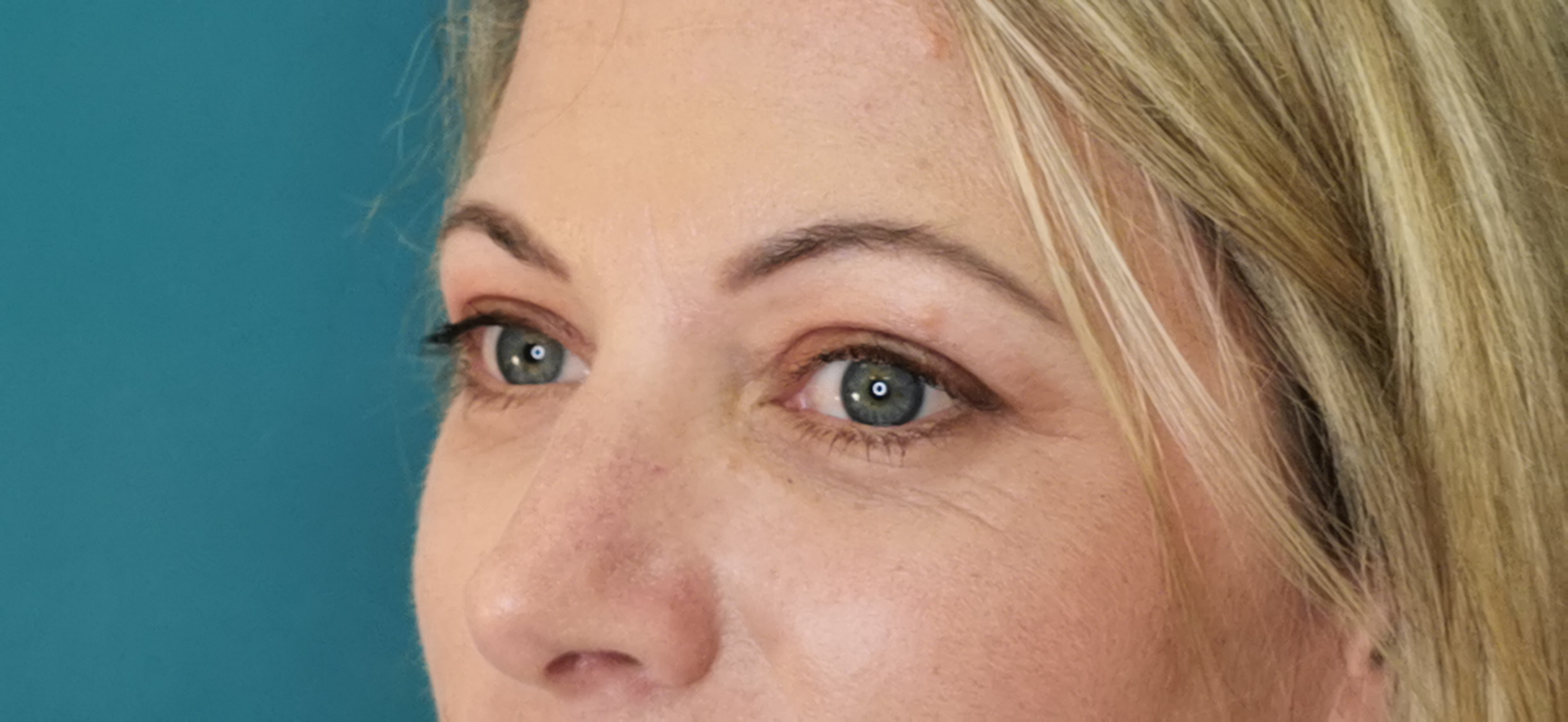 Browlift - baggy eyelids