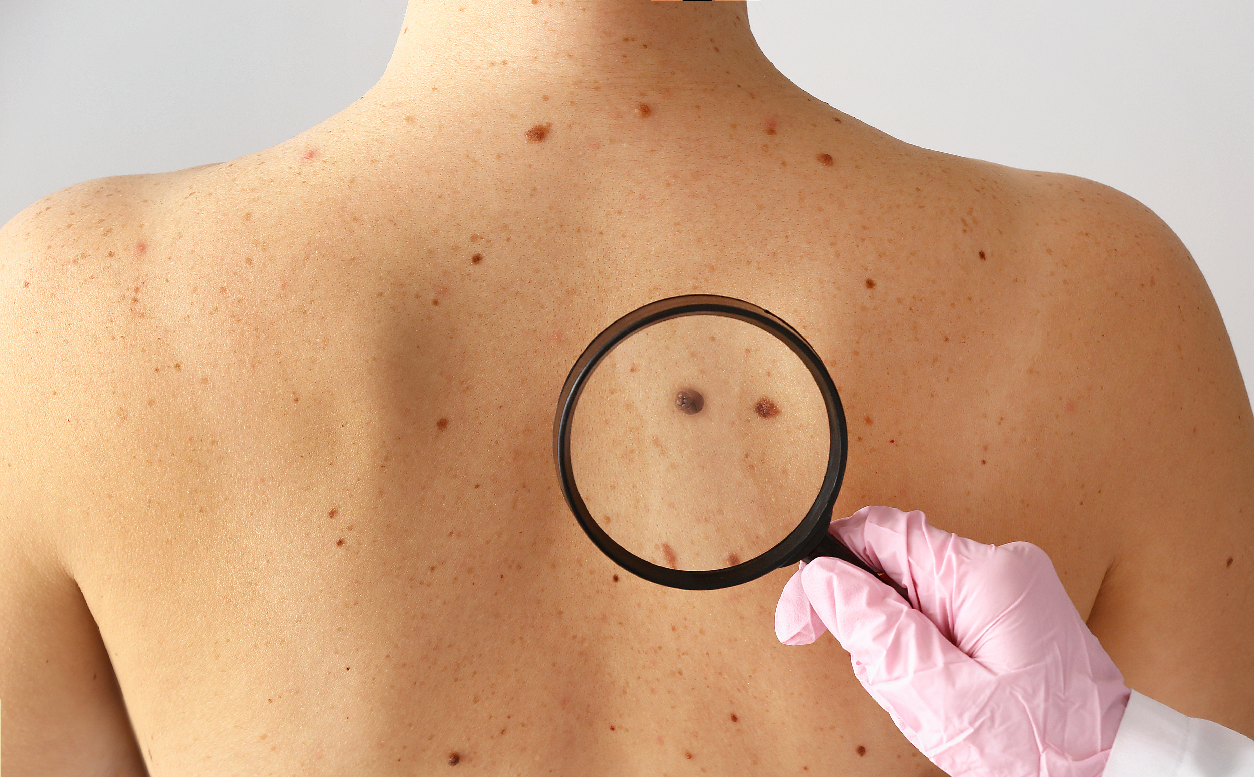 Melanoma Treatment - Skin Cancer - Bulent Yaprak