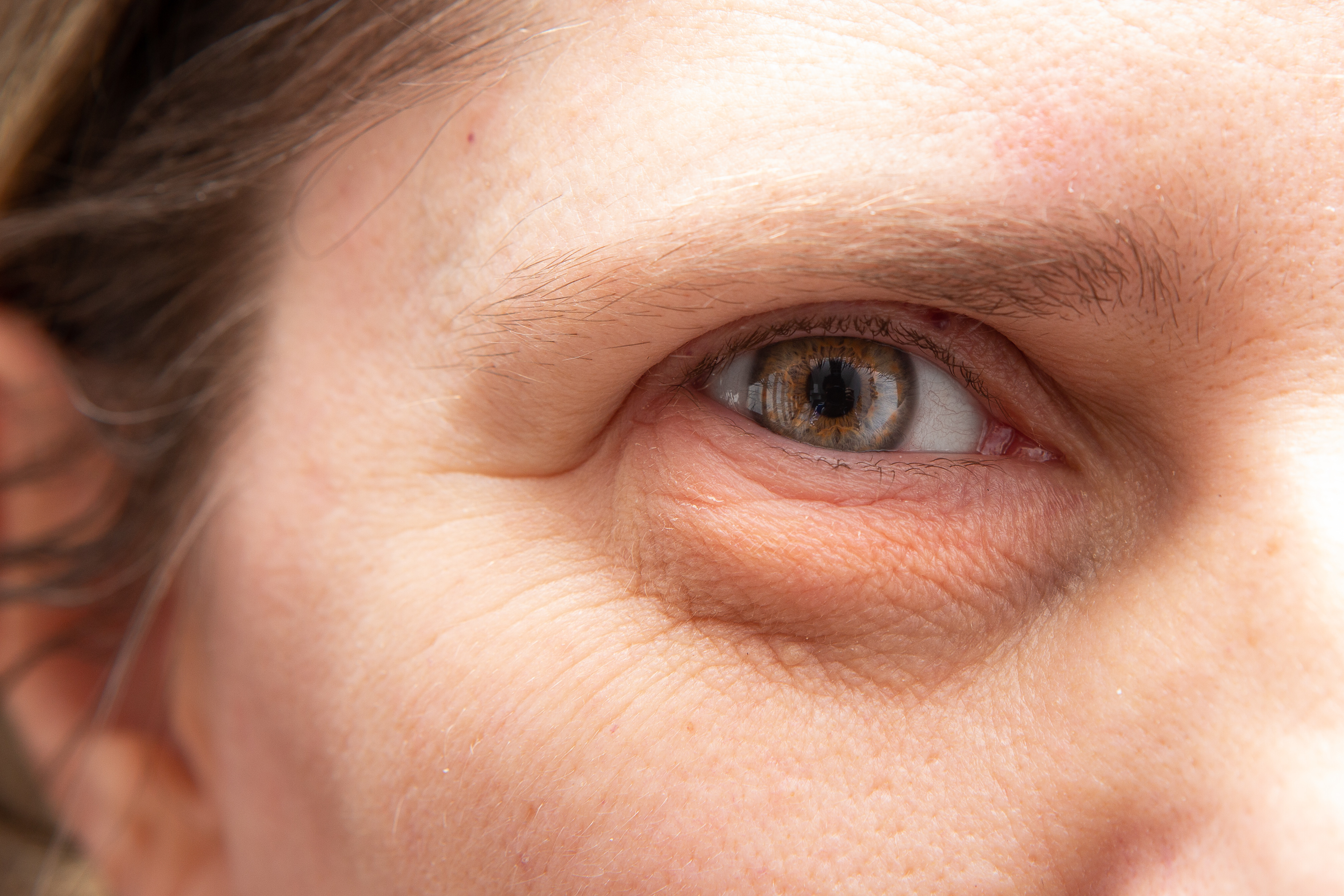 Lower eyelid blepharoplasty - baggy eyelids
