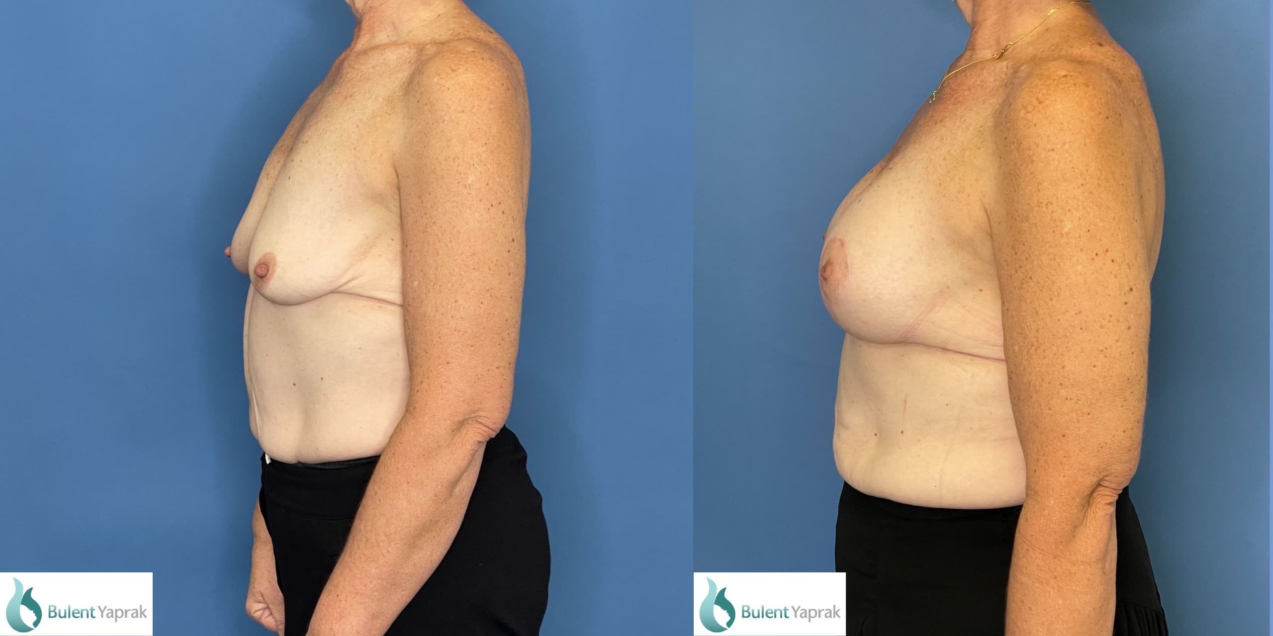 Side view of breast implants and mastopexy- breast lift. Before and after photos
