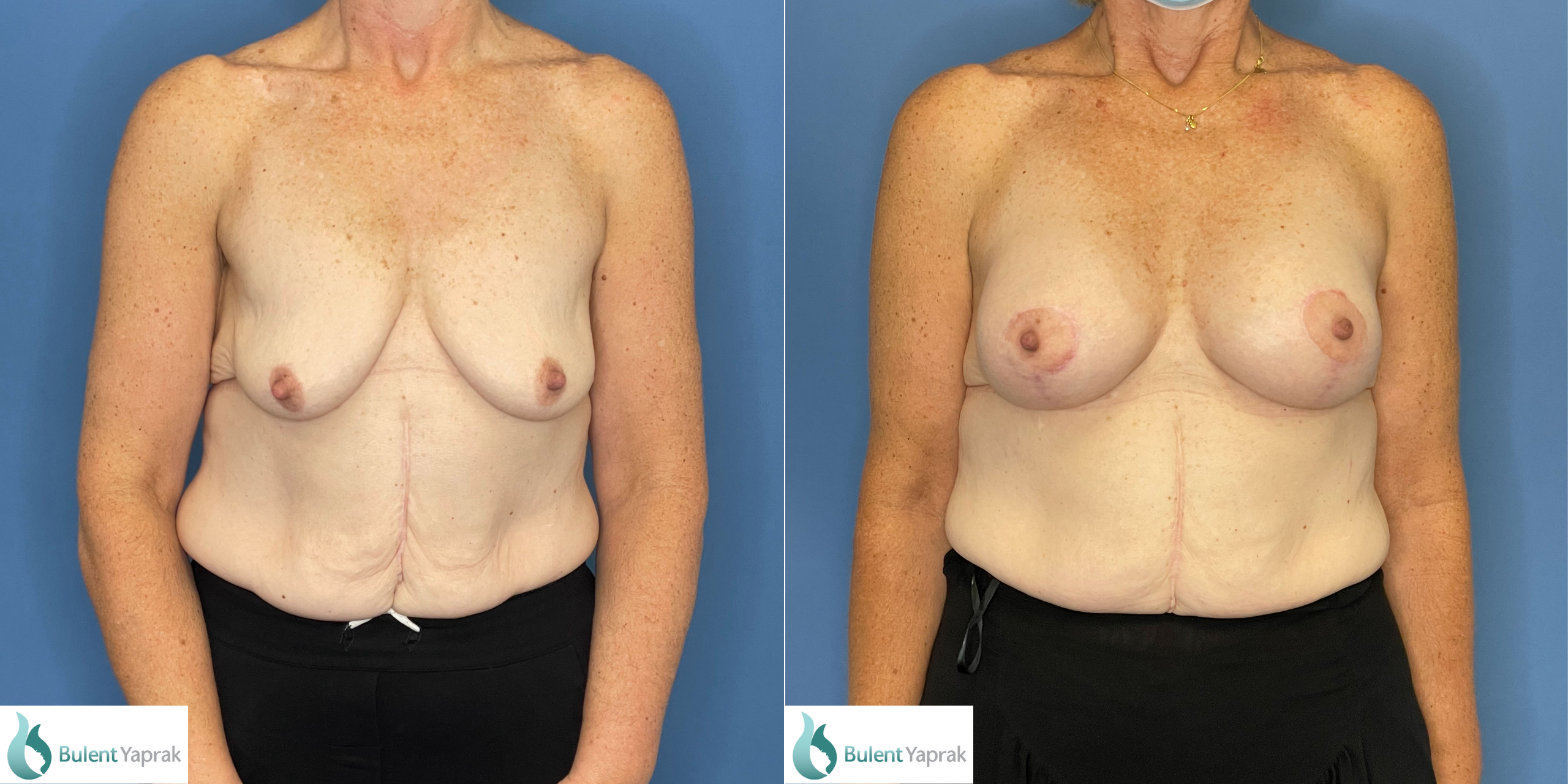 Bilateral breast augmentation and mastopexy before and after result