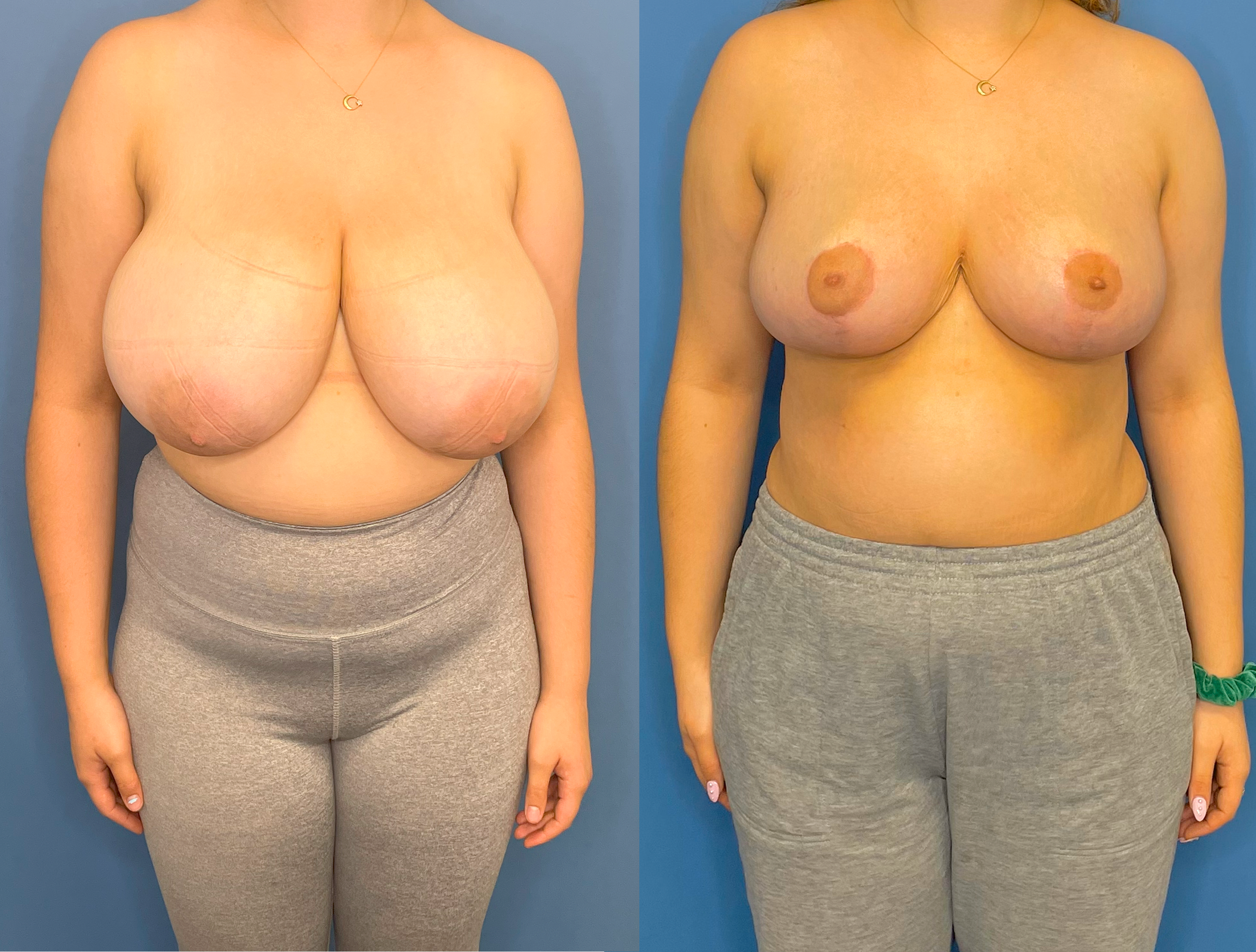 Breast Reduction Before and after photo