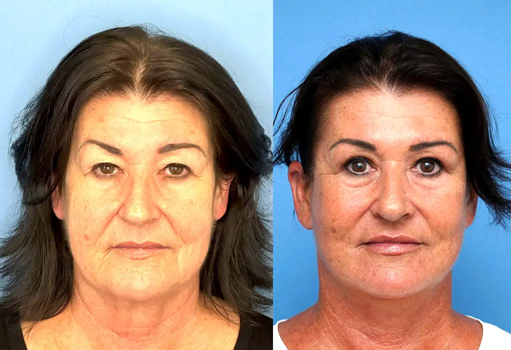 Mini Facelift Befpre and after photos Yaprak