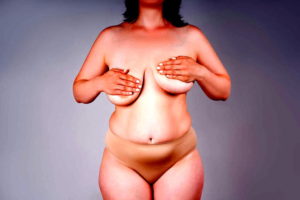 Breast lift image