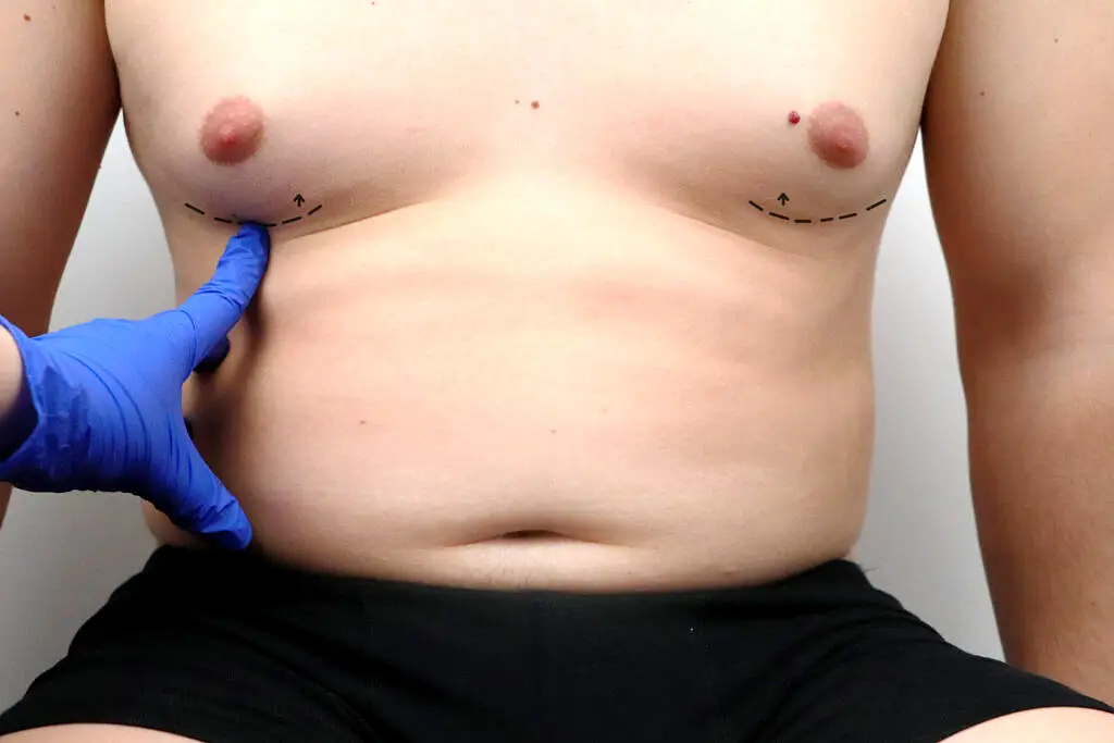 Gynecomastia surgery for men with Bulent Yarpak - man boobs